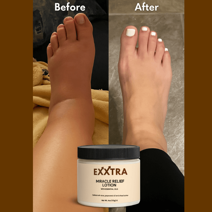 Miracle Relief Lotion - BUY 2 GET 1 (Swelling and Edema)